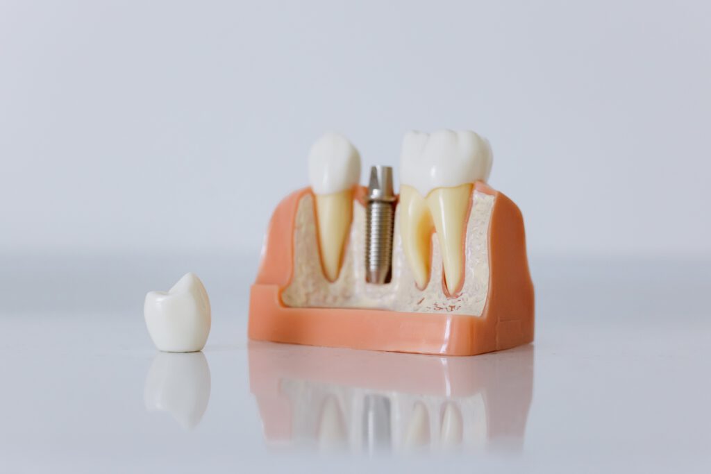 Herausforderung Zahnfarbe beim Zahnersatz