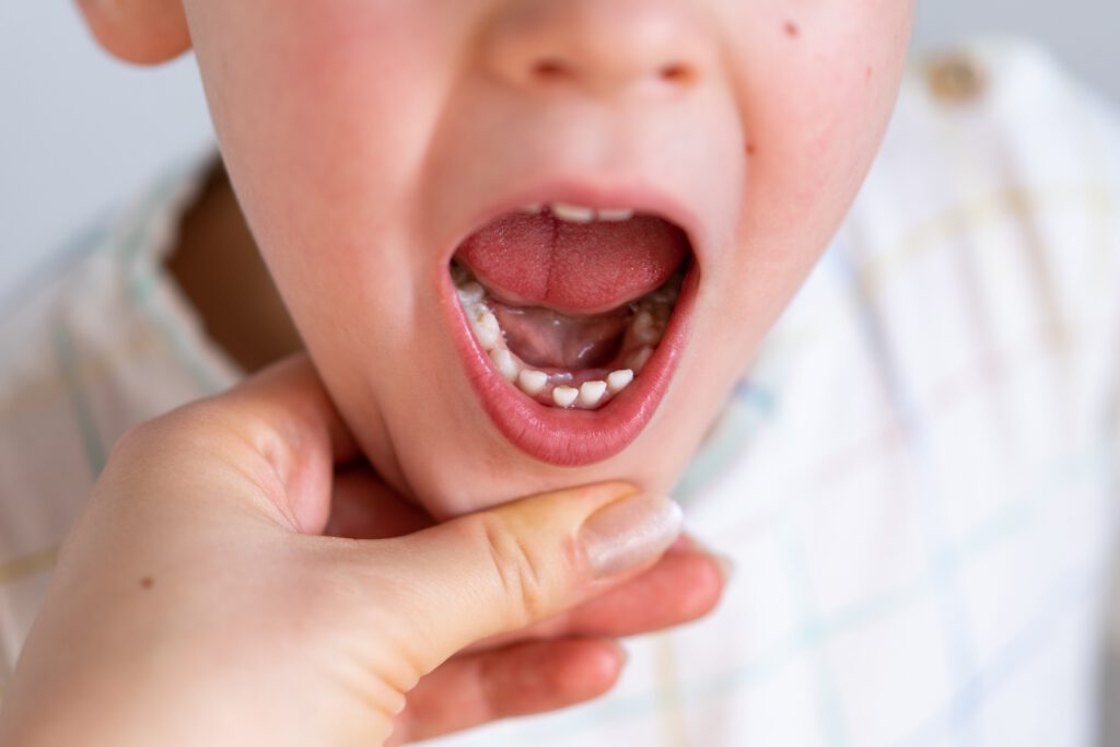 Zahnverletzungen bei Kindern: Was tun und wie vorbeugen?